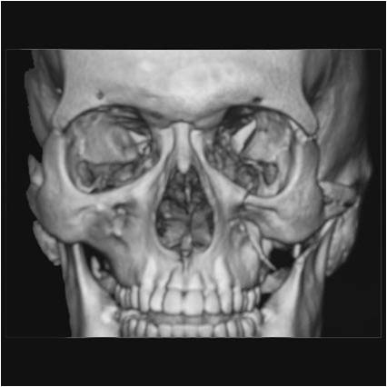 図１．左頬骨骨折の例