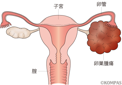 良性 卵巣 腫瘍