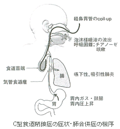 C型食道閉鎖症の症状・肺合併症の機序