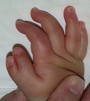 図１．おやゆびの多指症
