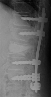 図2 椎弓根スクリューを併用した椎体形成術（骨折した椎体にリン酸カルシウムセメントを充填し安定性を獲得する）