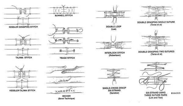 図３．様々な腱縫合法