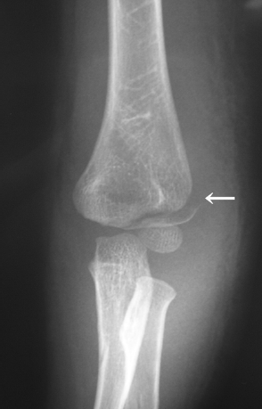 図４：小児上腕骨外側顆骨折