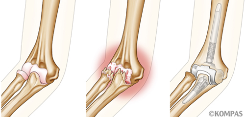 図１．左：正常の肘関節　中央：関節軟骨が変性した変形性肘関節症　右：人工肘関節置換術