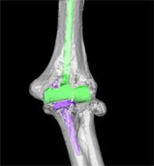 図２．術前の患者さんの肘関節をもとに計画した人工肘関節