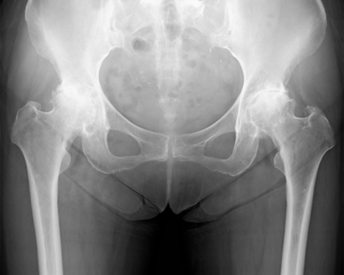 蓋 先天 不全 骨 臼 性 形成 臼蓋形成不全症 下肢関節の病気