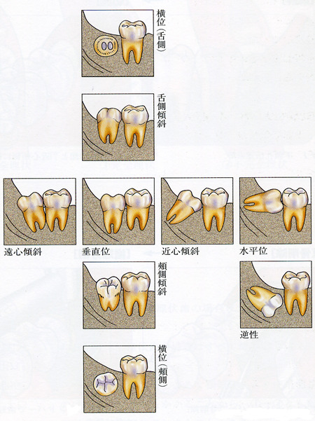 図. 埋伏智歯の分類