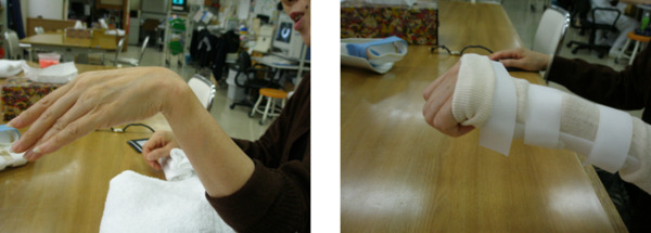 写真１．静的上肢装具：橈骨神経麻痺に対するコックアップ装具