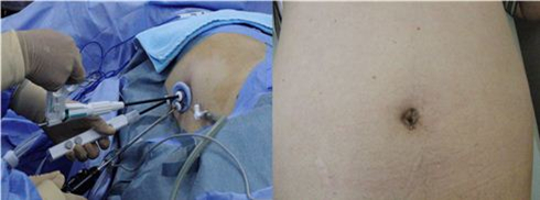 図２．左：単孔式手術（臍からのアプローチ）　右：副腎摘出術後の臍の様子（傷がない。）