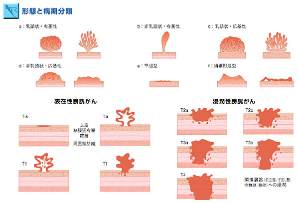 図１．膀胱がんの病期　（日本化薬株式会社　目で見る膀胱の病気　より）
