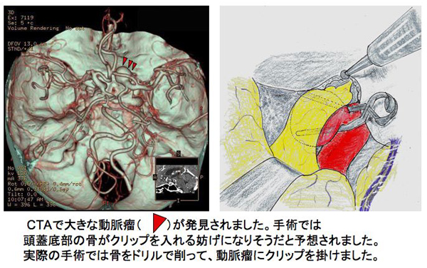 瘤 脳 動脈