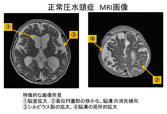 正常圧水頭症 MRI画像
