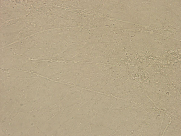 図２．KOH直接鏡検法で確認された皮膚糸状菌