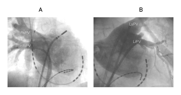 図２．左右肺静脈造影の様子