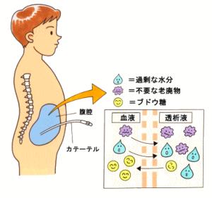 図1：腹膜透析の原理