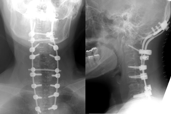 図2. 頸椎の手術後のレントゲン写真