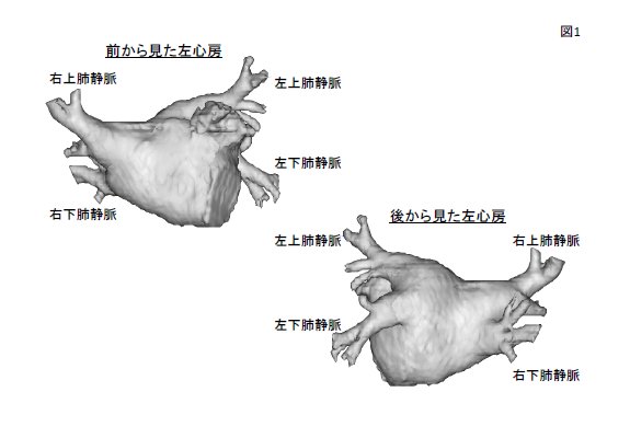 図１． CTスキャンから3次元的に作成した左心房