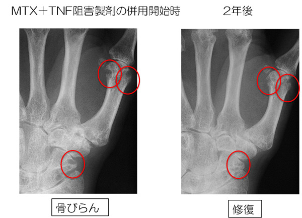 図2 赤で囲まれた骨びらんがTNF阻害剤開始2年後に修復されています
