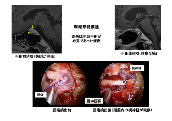 図６．鞍結節髄膜腫患者さんの例