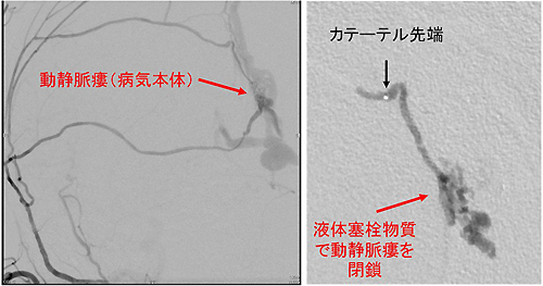 図3　硬膜動静脈瘻の経動脈的塞栓術の例