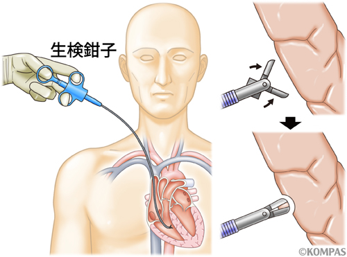 図２．心臓生検の方法