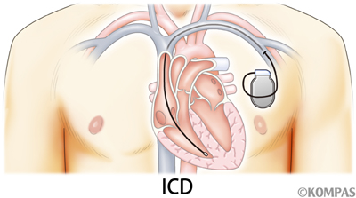 図3.植え込み型除細動器（ICD）