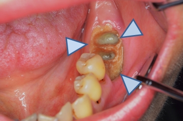 図２．BMA製剤投与後に見られた顎骨壊死（1）