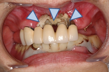 図３．BMA製剤投与後に見られた顎骨壊死（2）