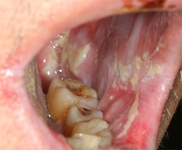 図１．がん化学療法による広範囲の口内炎