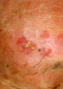 図１．湿疹として治療されていた日光角化症