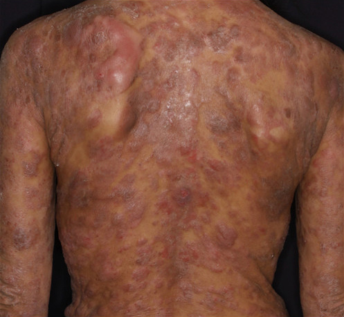 図１．菌状息肉症（腫瘍期）の背部