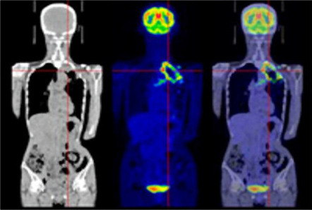 図1：肺がんのPET/CT画像