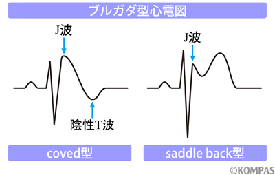 図2　ブルガダ症候群の心電図波形