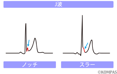 図3　J波を伴う特発性心室細動の心電図波形