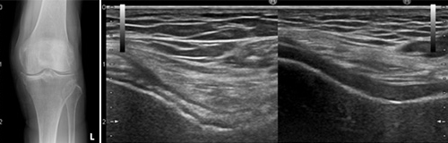 図１．膝関節の石灰化　　図２．ピロリン酸カルシウム結晶の膝軟骨内沈着（左：患者さん、右：健常者）