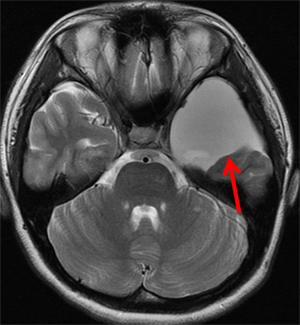 図1　10代女性でMRI上シルビウス裂から中頭蓋窩にかけてくも膜のう胞を認めます。症状は全くありません。