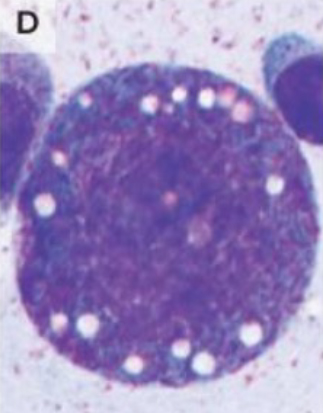 図３．骨髄前駆細胞における空胞像（N Engl J Med.383(27):2628-2638,2020の図を引用））
