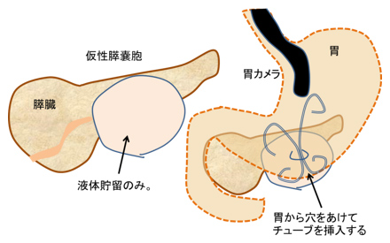 図１．仮性膵嚢胞および仮性嚢胞ドレナージ術