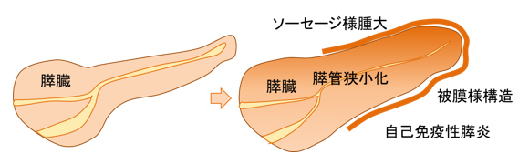 自己免疫性膵炎 慶應義塾大学病院 Kompas