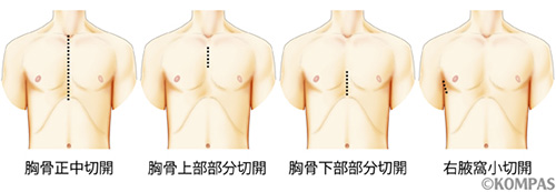 図１．大動脈弁手術時における切開の範囲