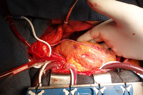 図２．心臓外科手術における胸骨正中切開法