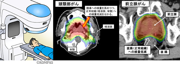 図２．頭頚部がんおよび前立腺がんのIMRT照射例