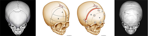 図３．生後11か月の前頭縫合早期癒合症（三角頭蓋）に対して一期的頭蓋形成術を行った症例