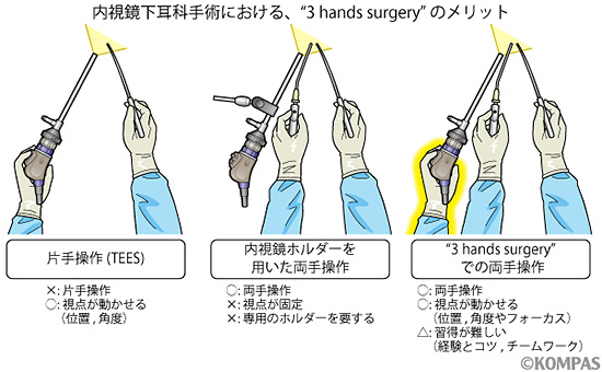 図４．内視鏡下耳科手術における