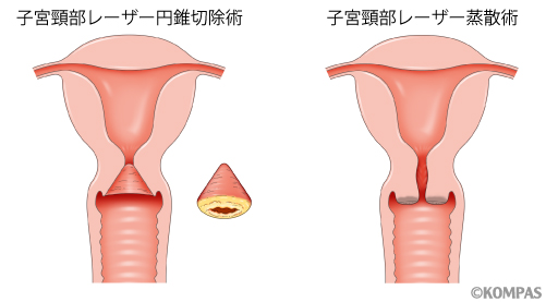 図１．子宮頚部円錐切除術と子宮頚部レーザー蒸散術の比較
