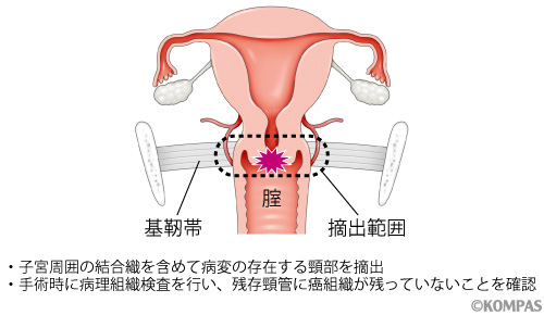図３．広汎性子宮頸部摘出術