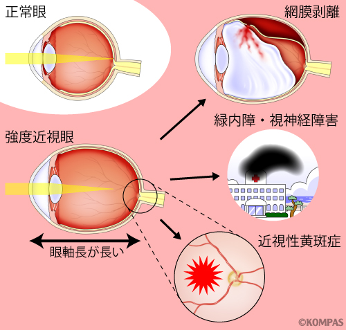 図1. 強度近視に合併しやすい眼疾患