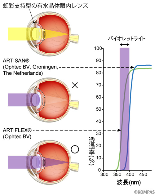 図2. 2つの有水晶体眼内レンズの比較