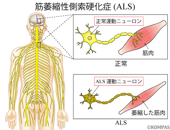 図1．筋萎縮性側索硬化症（ALS）