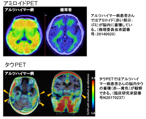 図2. 新しい認知症PET検査